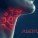 Adenoidid